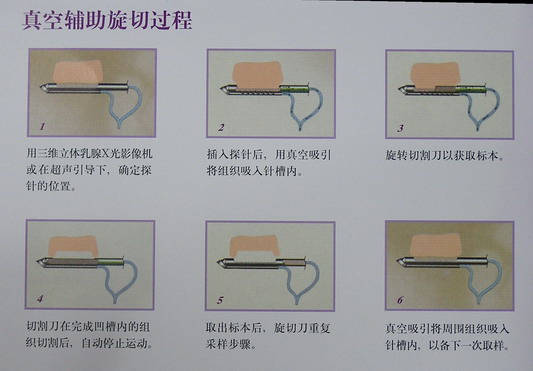 至臻完美麦默通旋切术